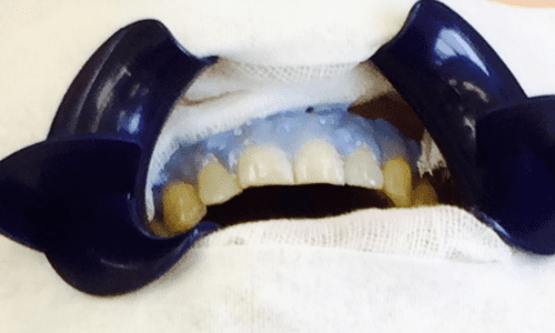 ホワイトニング歯肉保護