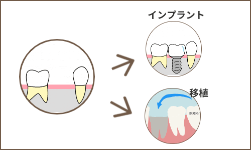 歯がなくなった場合