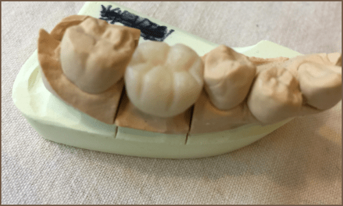 奥歯の仮歯