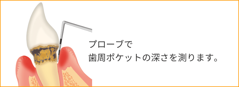 歯周ポケットの深さを測る