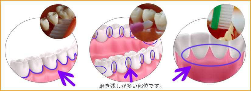 磨き残しに注意