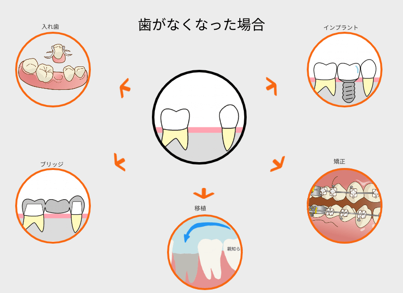 歯がなくなった場合の治療法