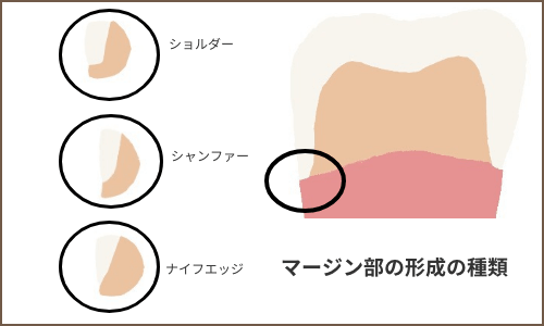 マージン部形成