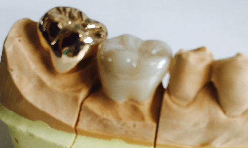  奥歯のマージン