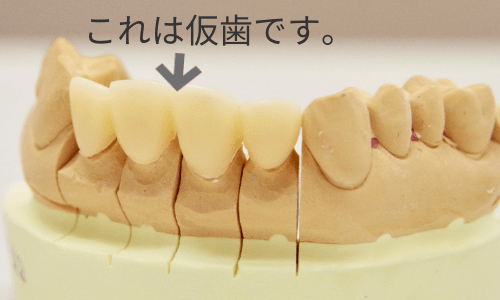 仮歯つき模型
