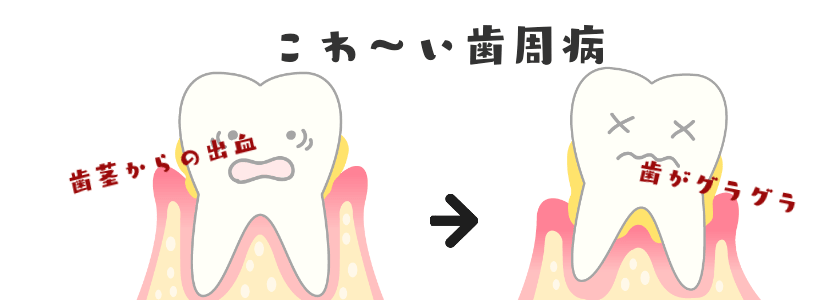 怖い歯周病