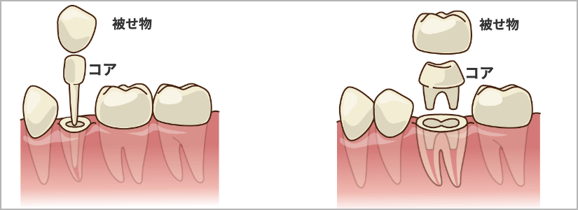 コアつきセラミック被せもの