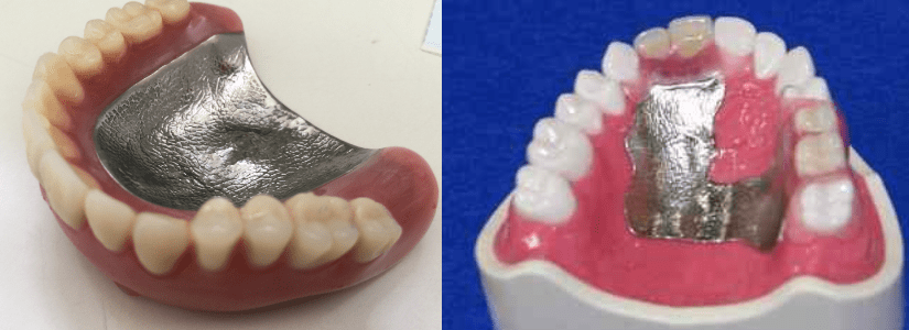 金属床チタン義歯