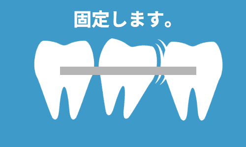 動揺のある歯は固定