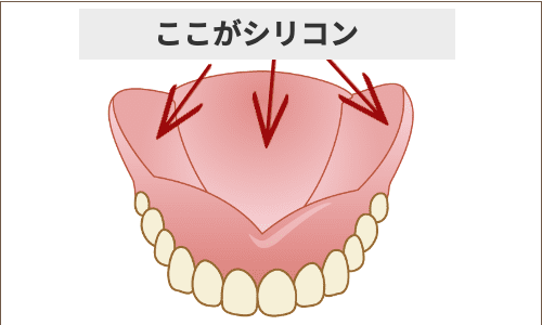 入れ歯　柔らかい